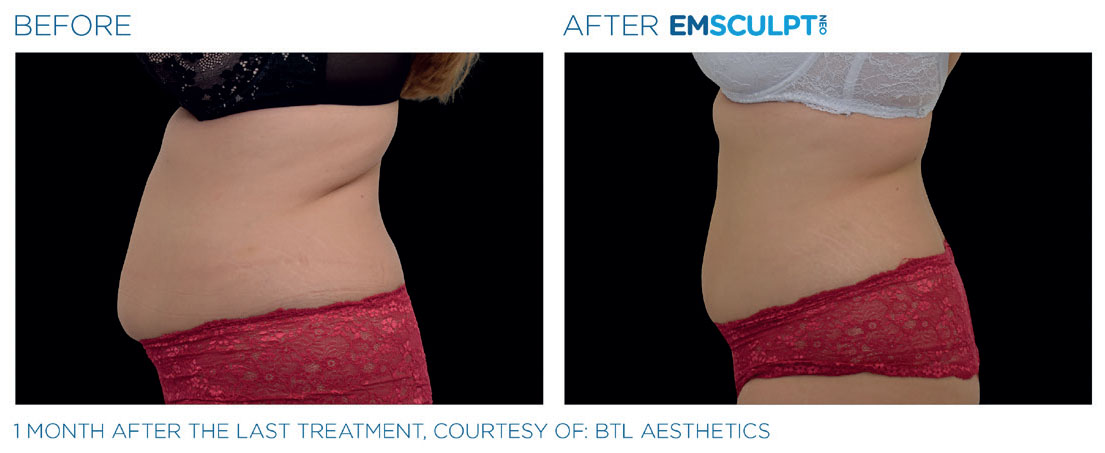Before and after of a female 1 month after the last treatment of abdomen.