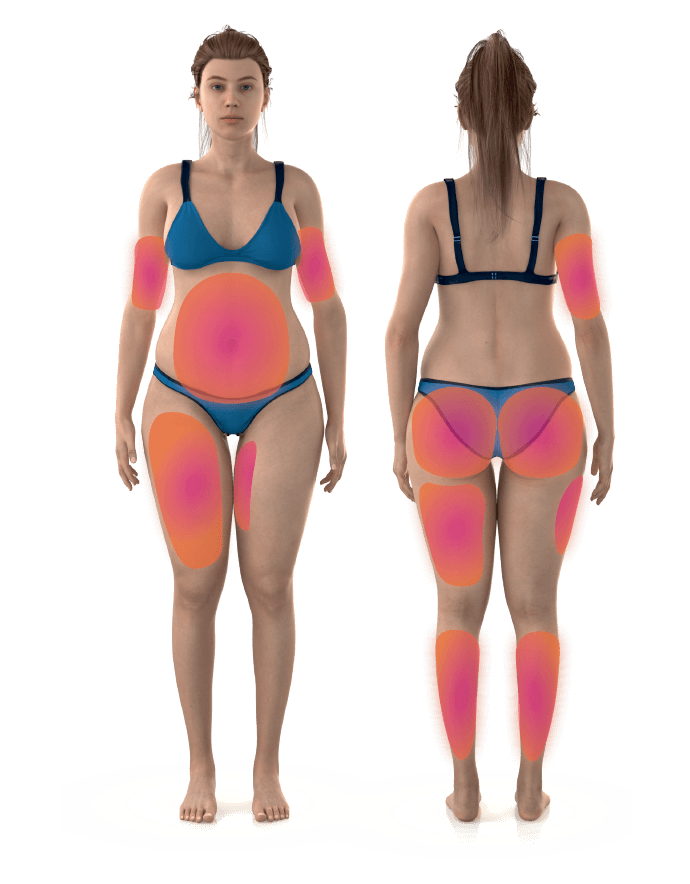 diagram showing the areas of the female body where emusculpt can help